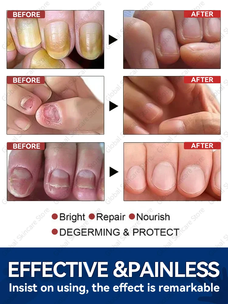 Foot Nail troubles Solved completely foot care tool foot pedicure tool ingrown toenail correction tool nail repair nail cuticle softener toenail fungus patch