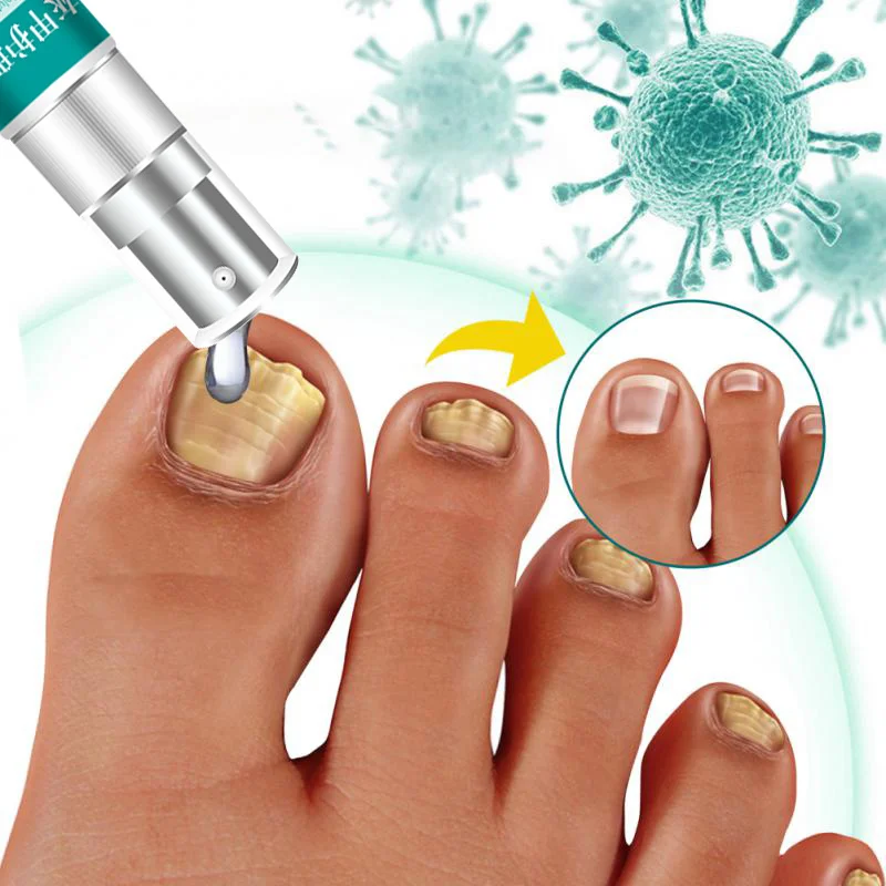 Nail Fungus Treatments Serum Spray Repair Toe Nail Fungal Removal