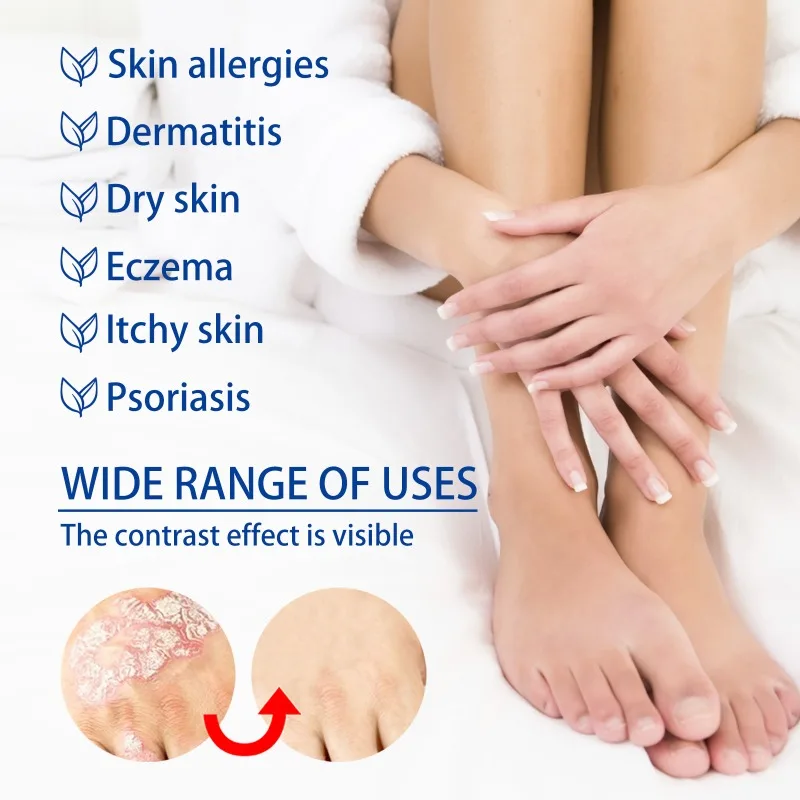 Psoriasis Ointment Anti-Itching Skin Repair Problems Treatment Eczema Dermatitis Antifungal Topical Body Care Essence Ointment