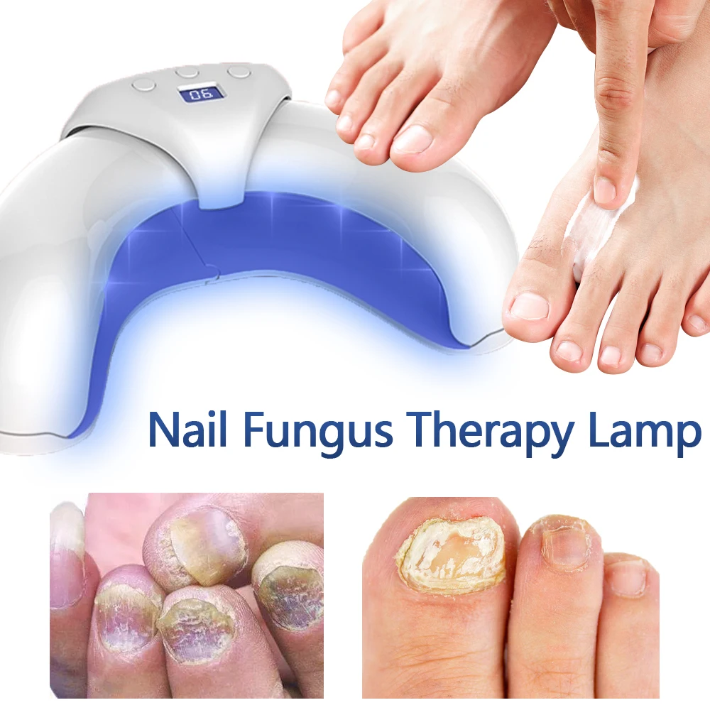 FungalNailLaserDeviceRepairFastNailsFungusOnychomycosisRepair
