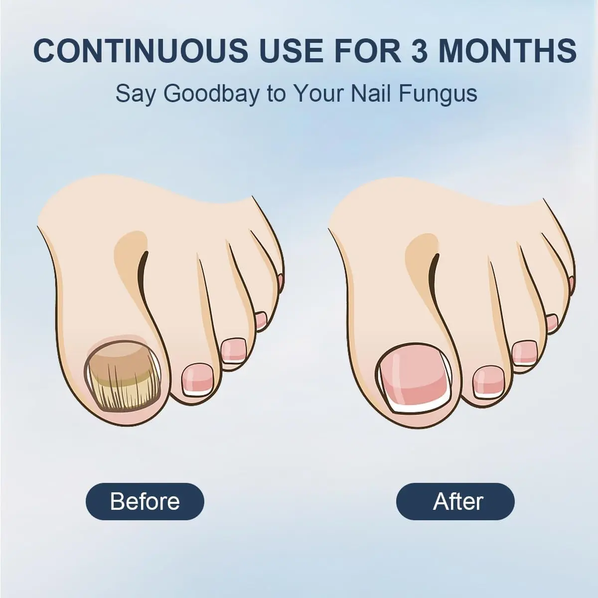 48W Nail Fungus Laser Treatment Device Digital Display 905nm Infrared Light 470nm Remove Fungal Nail Blue Therapy Anti Fungal nail fungus remover laser therapy pen