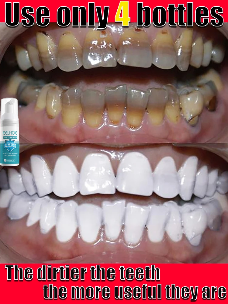 Tooth Stain Removal Gum Bleeding Whitening Deep Cleaning Dental Plaque