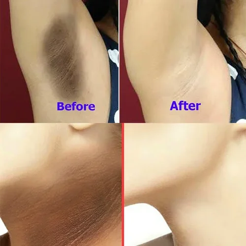 글루타티온 미백 비누, 멜라닌 색소 침착 제거, 어두운 피부 미백, 겨드랑이 무릎 엉덩이 부위 미백, 개인 표백제 2