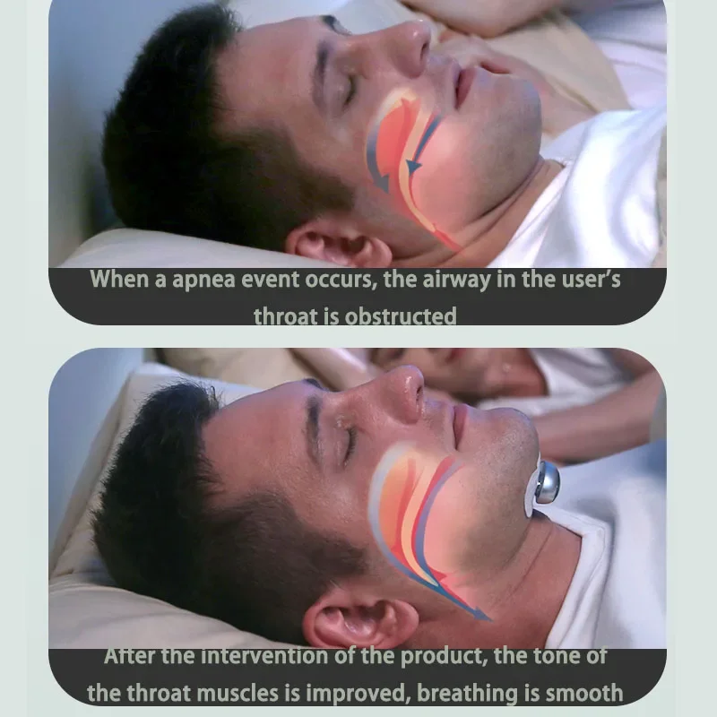 YA4300 smart anti-snoring home anti-snoring artifact nose snoring snoring fire