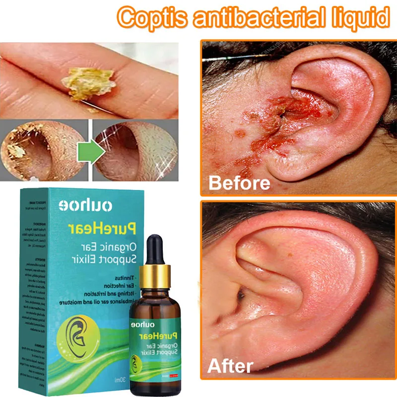 Tinnitus Ear Drops Treatment Tinnitus Deafness Otitis Hard Hearing Repair Ear Swelling Itching Earache Beauty Health Products