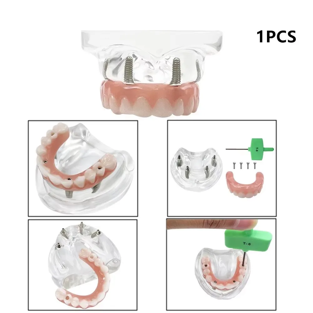 Modello di Impianto Dentale 4 Volte Analisi Rimovibile 'analisi Rimovibile Modello di Dimostrazione del Ponte