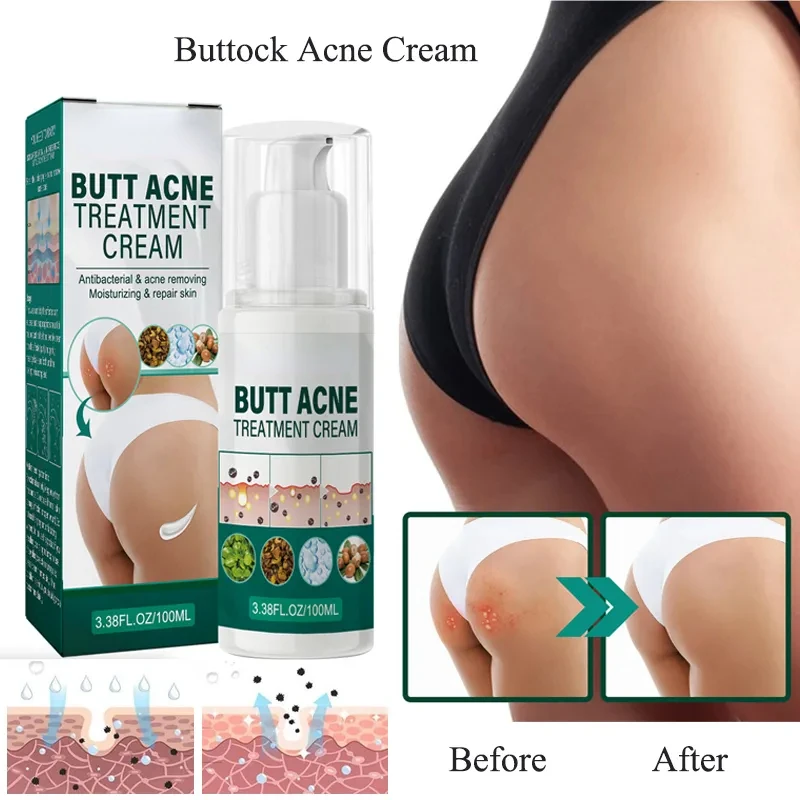 Acne Treatment Cream Remove Acne Marks On Buttocks Natural Ingredient  Black Dots Remove Acne Cream Skin Care Beauty Health