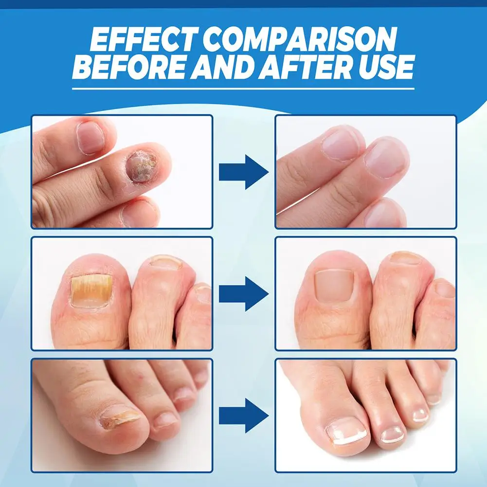 Nail Fungus Treatment Pen Anti-fungal Repair Pen Blue Light Laser Paronychia Nail Onychomycosis Painless Removal Care Tool