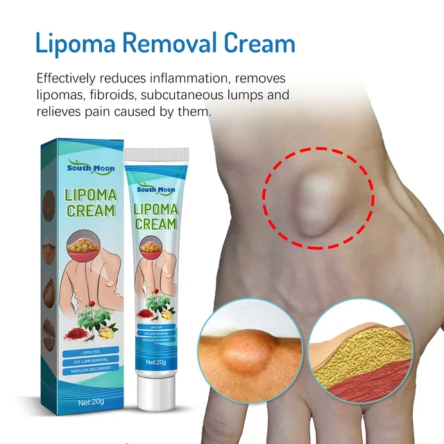 리포마 제거 크림: 지방 덩어리 완화와 피부 건강 증진