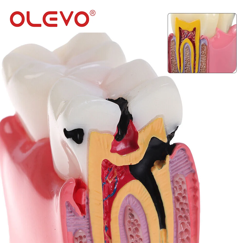 OLEVO 치과 교육 치아 모델 6 배 우식 비교 데모 학생 공부 치과 실험실 훈련 틀니 모델