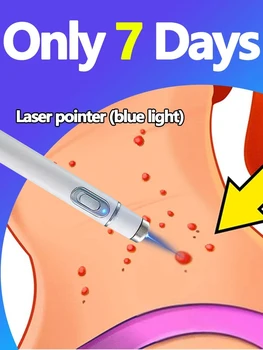 Vendi come le torte calde Generazione-2 Laser dice addio a tutte le verruche in 7 giorni