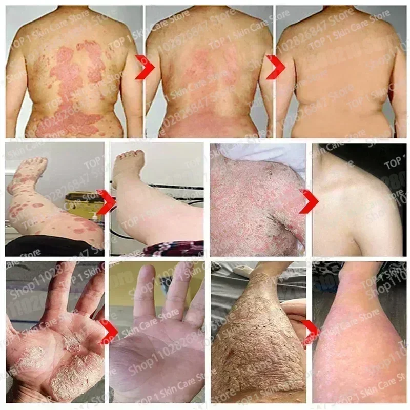 Psoriasis Antibacterial Anti-itch Dermatiti Eczema Urticaria Alergy Skin Beauty Health Body Care