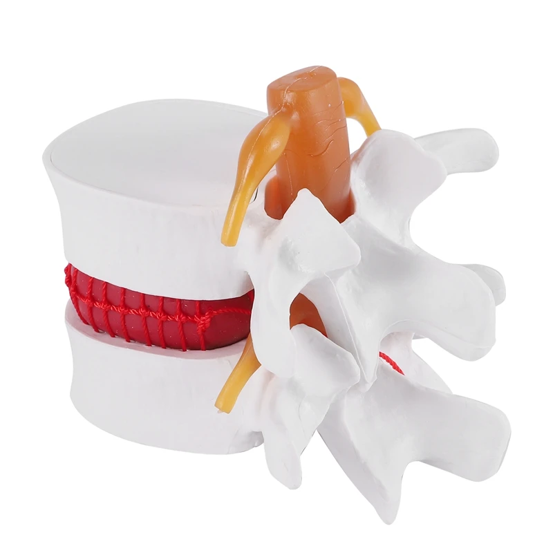 

1:1.5 Human Lumbar Disc Herniation Demonstration Model Of Lumbar Vertebral Spine Model For Human Anatomy