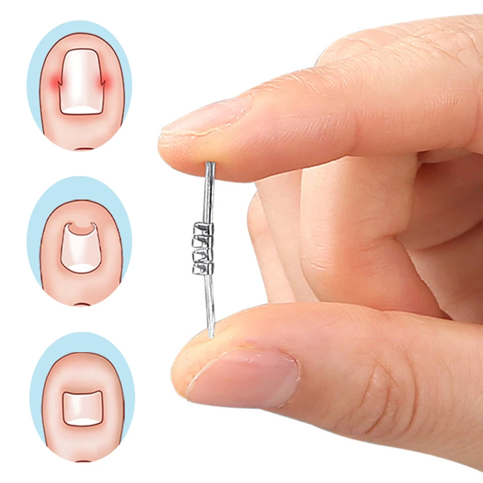 Ingrown Toenail Correction Tool for Foot Care