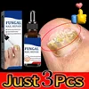 Fungal Nail Laser Treatment Device Repair Toenail Anti Infection Paronychia Onychomycosis Ingrown Toenail Foot Care Essence 1