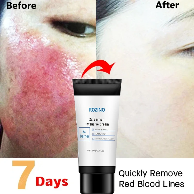 

7 Days Treatment Facial Redness Cream Repair Soothing Sensitive Skin Rosacea Itching Improve Moisturing Care Korean Cosmetics
