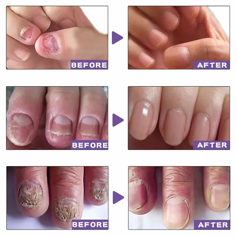 Fungal nail treatment serum foot nail fungus removal repair gel anti infection paronychia onychomycosis foot nails care essence