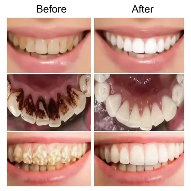 Dentes-roxos-Whitening-Creme-dental-Remover-manchas-de-placa-Limpeza-Higiene-Oral-Ferramentas-Dental-Bleach-H.png