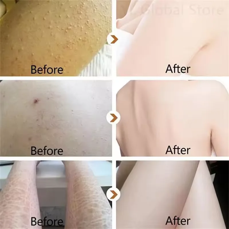 New Chicken Skin Repair Cream Curing Keratosis Follicle Pilaris Remove Thick Pores Body Dark Spot Moisturize Smooth Skin Care 2
