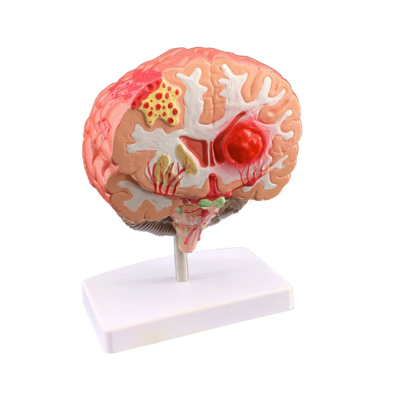 

Human Brain Pathology Hemorrhage Aneurysm Anatomy Model Medical Science Teaching Resources Dropshipping