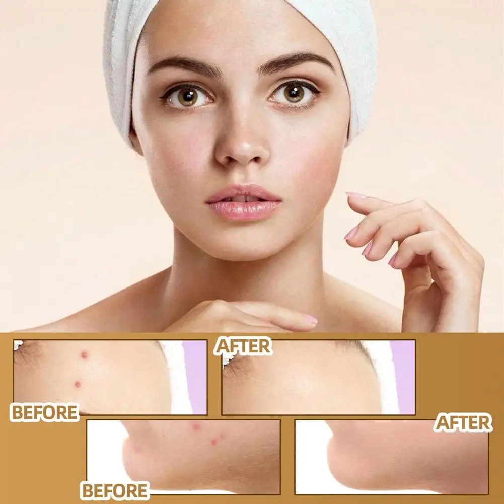 

60Pcs/Box Acne Scar Sticker Universal Wound Repair Scar Sticker Waterproof Lighten Pigmentation Invisible Scar Stickers