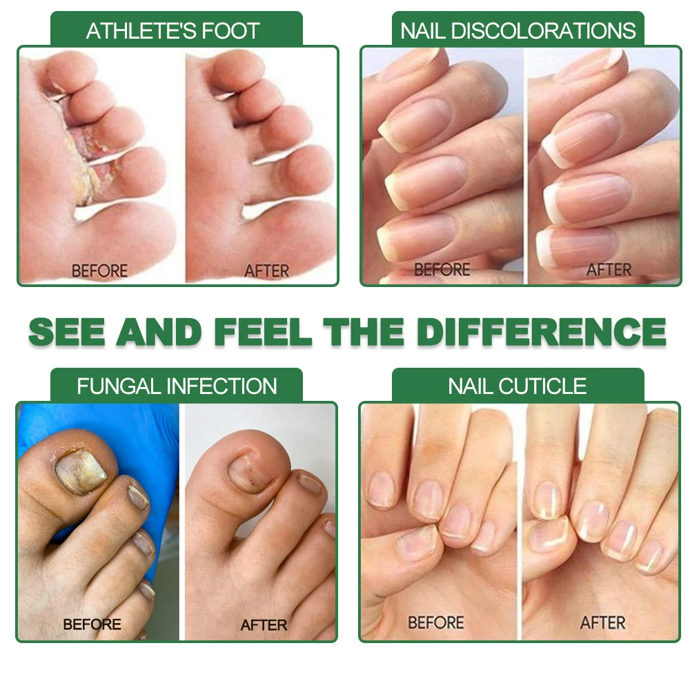 Fungal Nail Treatment Serum 7 Days Foot Nail Fungus Removal Repair Gel Anti Infection Paronychia Onychomycosis Foot Nails Care