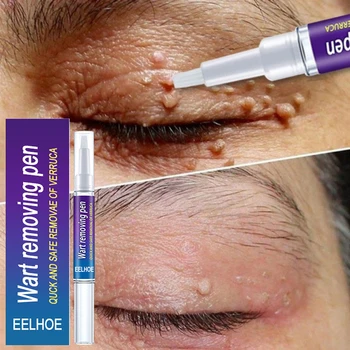 Wart Removal Mole Remedy Liquid Pen Treatment Papillomas Removing Skin Labels Flat Wart Genitals Painless Beauty Herbal Cream 1