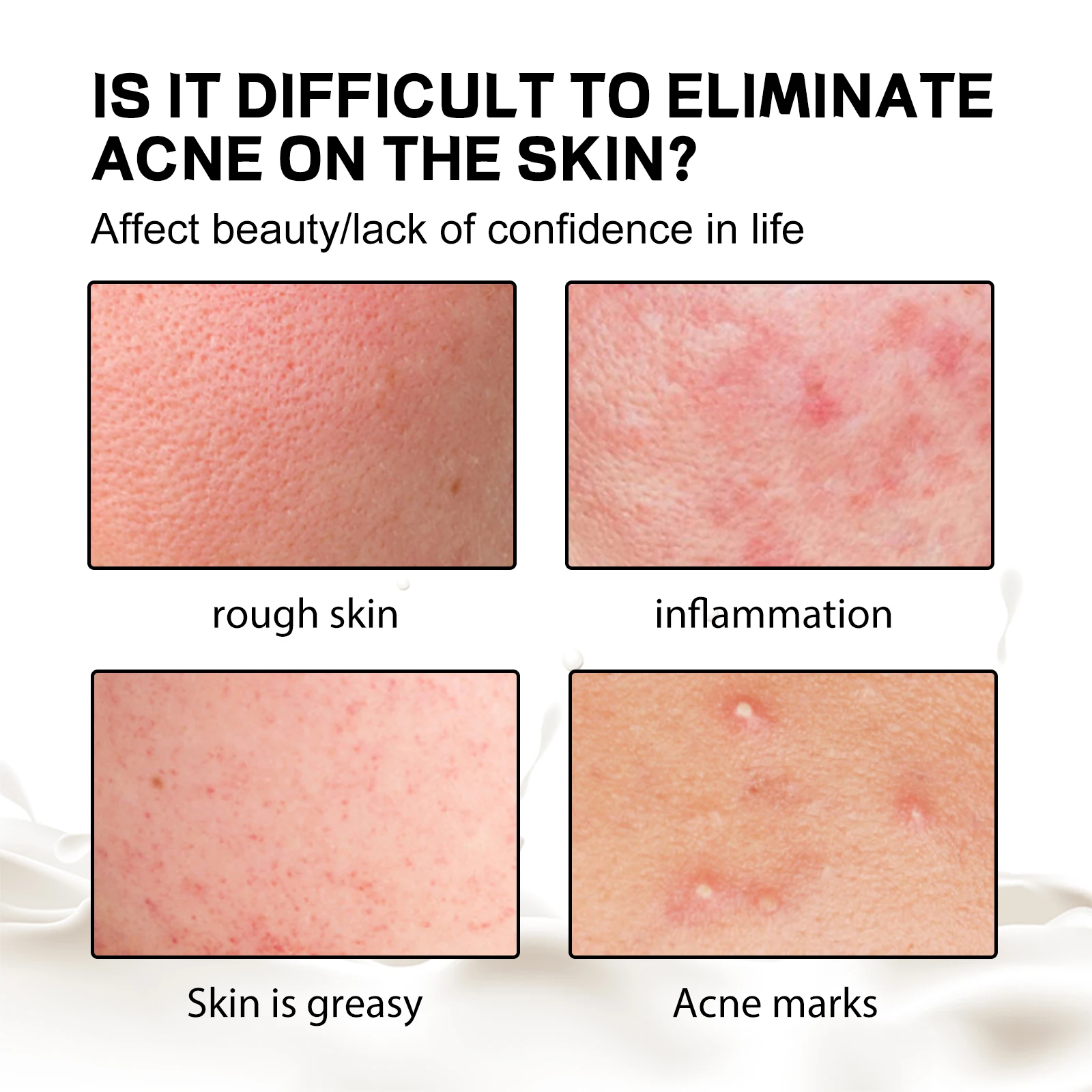 Back Acne Treatment Soap Deep Cleansing Exfoliating Fade Pigmentation Removal Pimples Oil Control Moisturizing Lighten Foam Soap