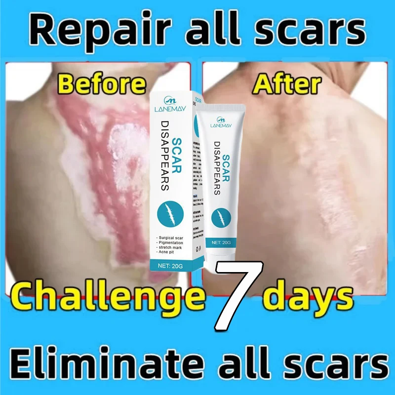 

10PCS Scar Removal Cream Repair Stretch Marks Burn Surgical Acne Scars Gel Herbal Treatment Gel Whitening Smooth Body Skin Care