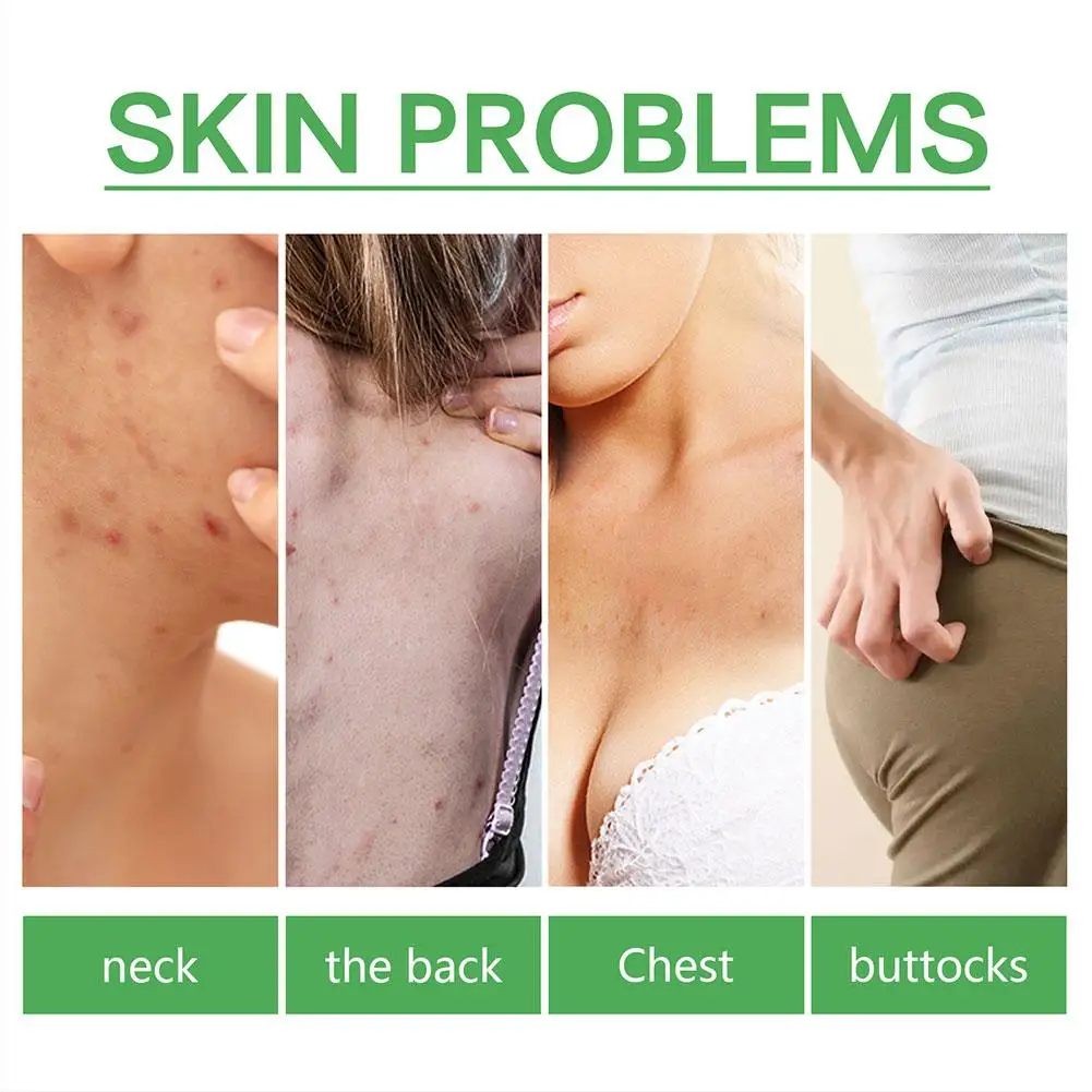 30ml Acne Remover Face Serum Herbs Acne Treatment Pimple Remover Shrink Pores Oil Control Face Herb Acne Skin Care_voghion.com