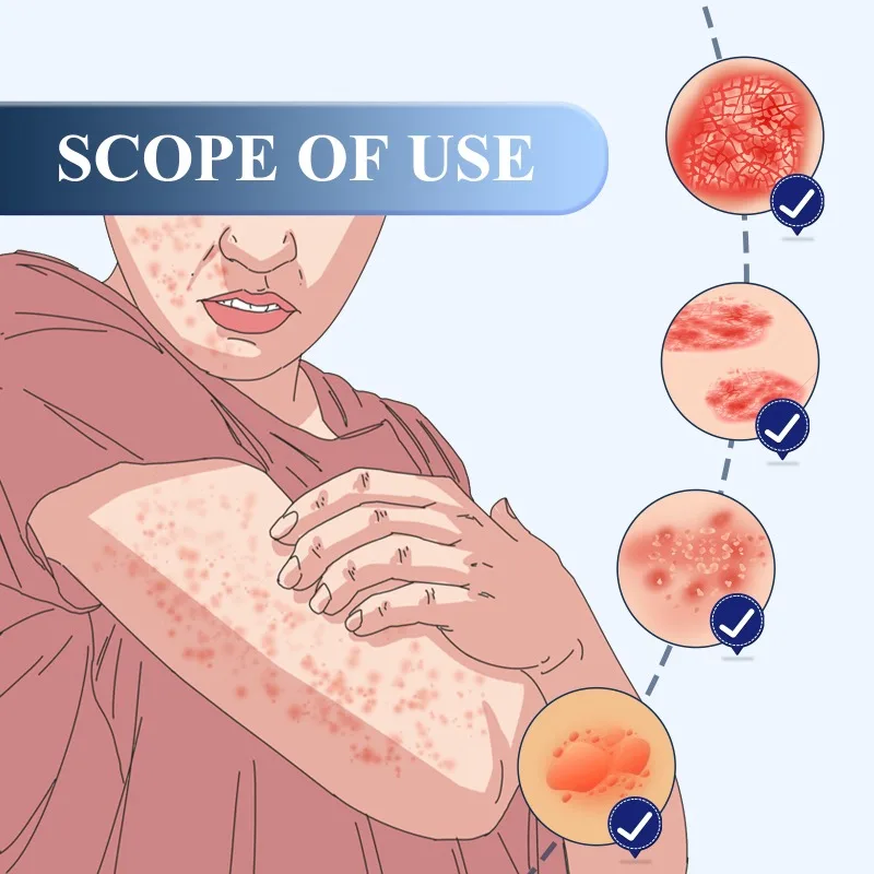 Psoriasis Treatment Spray Antibacterial Anti-itch Dermatiti Eczema Urticaria Alergy Skin External Use Beauty Health Body Care