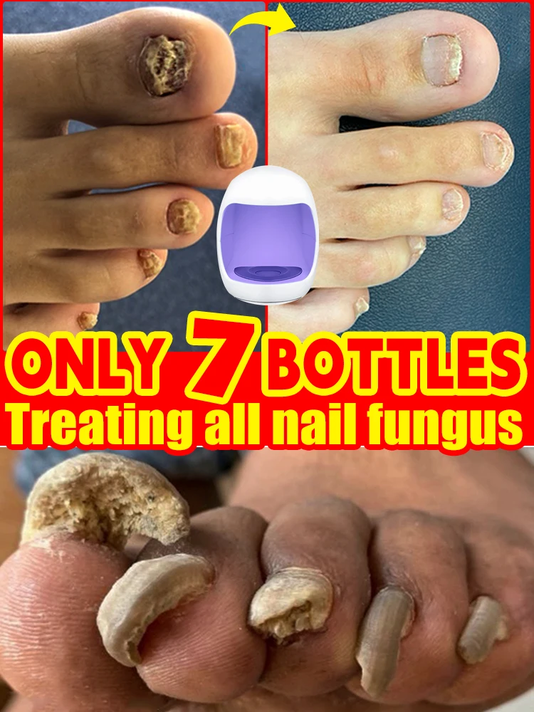 

Fungal Nail Laser Device Repair Fast Nails Fungus Onychomycosis