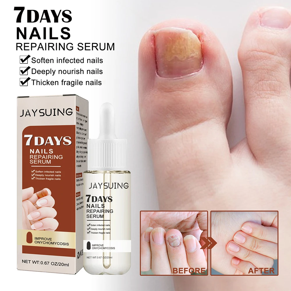 Nail Fungus Treatment Serum Toe Fungal Repair Products Hand Foot Care Removal Gel Anti Infection Onychomycosis Paronychia nail fungus remover