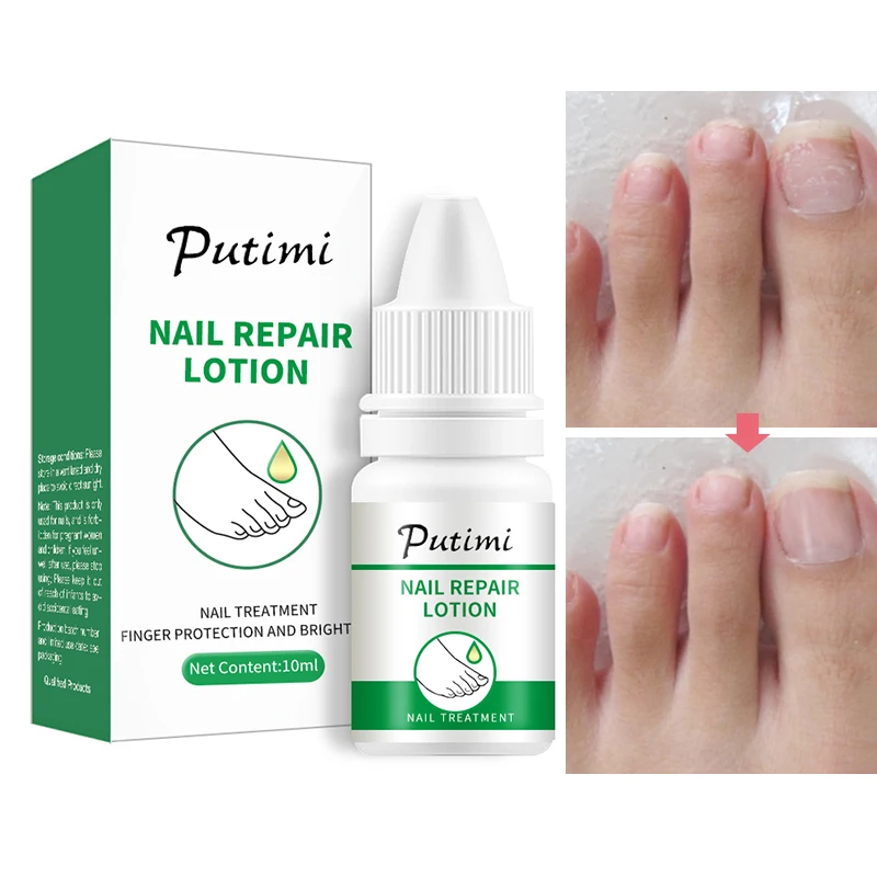 PUTIMI Nail Repair Essence Feet Care Serum Toe Nails Nourishing
