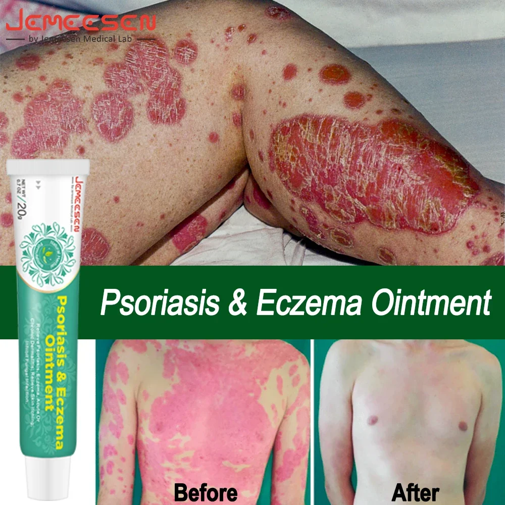 

Jemeesen Psoriasis Cream Eczema Antibacterial Ointment Relieve Skin Itching Swelling Remove Dermatitis Anti-Fungus Cream