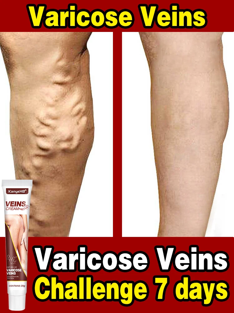 

Varicose Vein Relief Cream Effective Eliminate Vasculitis Phlebitis Spider Legs Treatment Soothing Relieve Pain Herbal Ointment