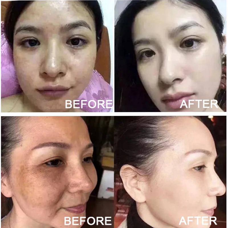 Whitening Serum Fade Dark Spot Freckle Brighten Essence Remove Pigment Melanin Correcting Beauty Face Skin Care