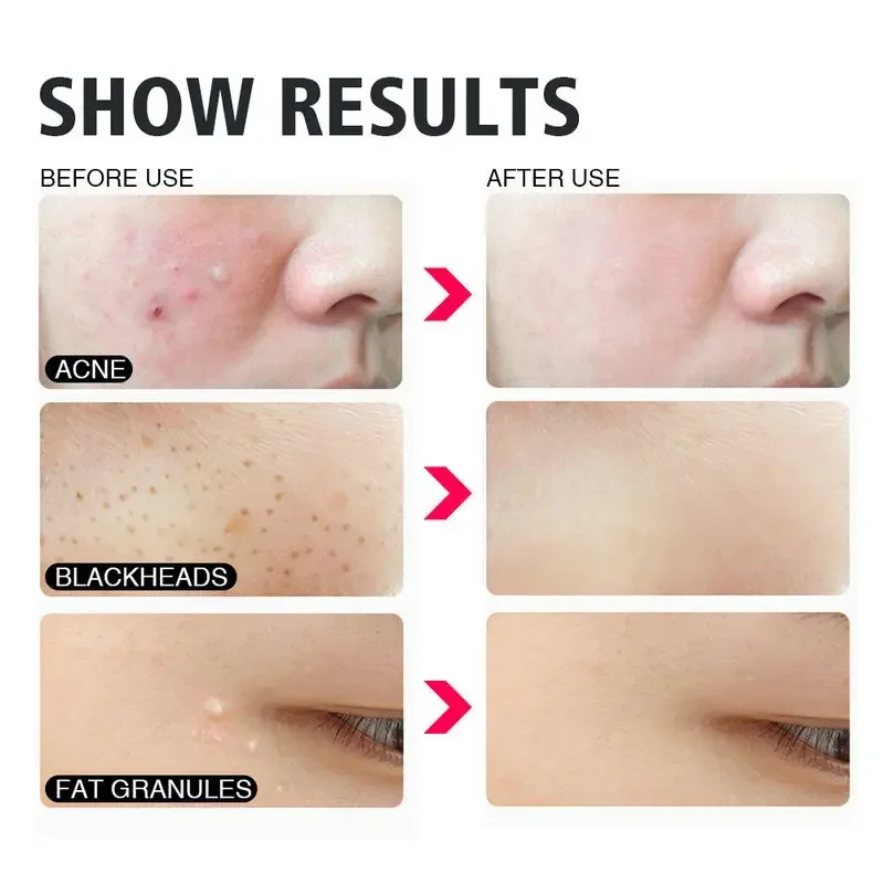 Blackhead Remover Acne Remover 4Pcs/Set Blackhead Comedone Acne Pimple Belmish Extractor Vacuum Blackhead Remover Tool Spoon Rose Gold For Face Skin Care Tool