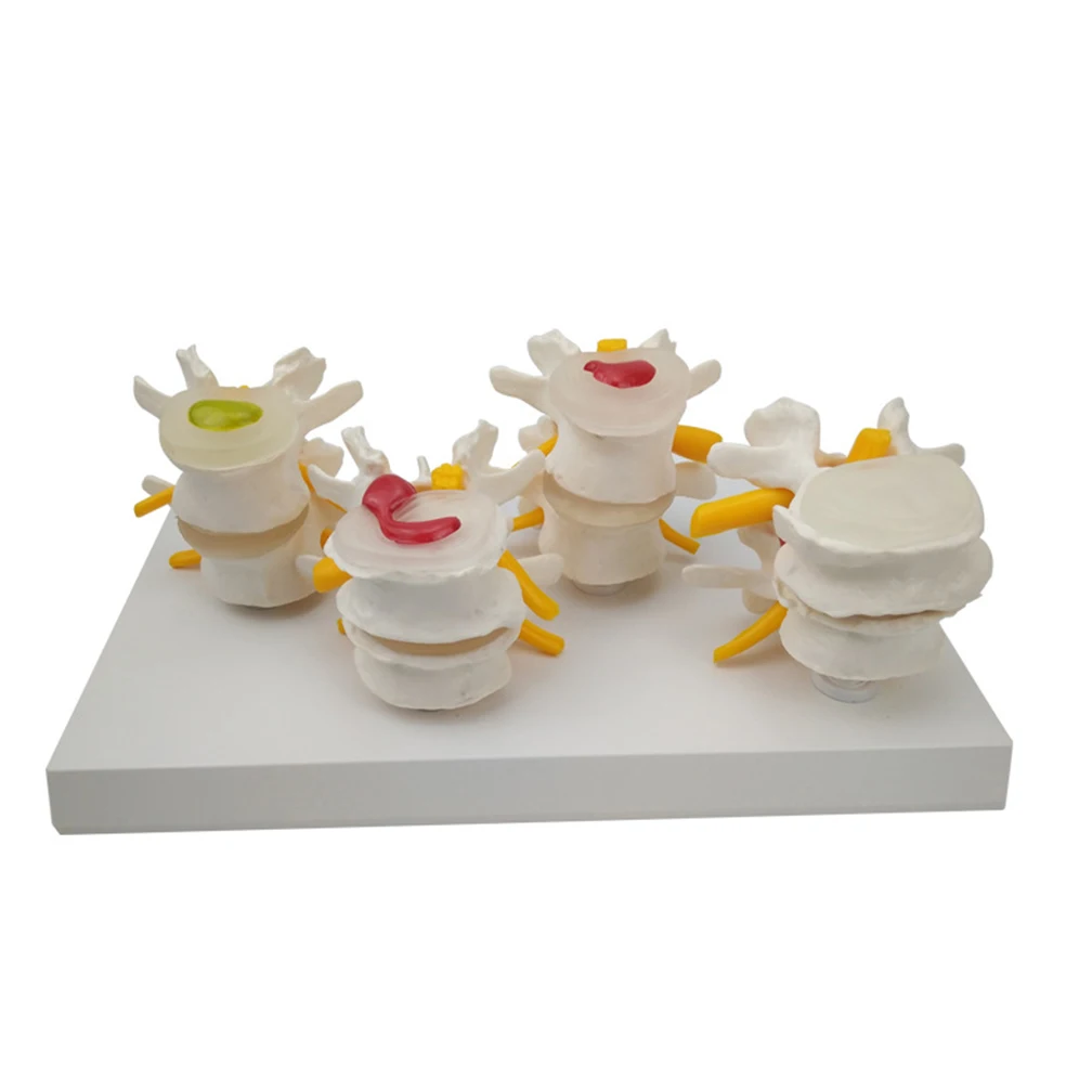 4-stage Pathological Human Lumbar Spine Anatomy Model Medical Science Teaching Resources Orthopedic Teaching Display Tools