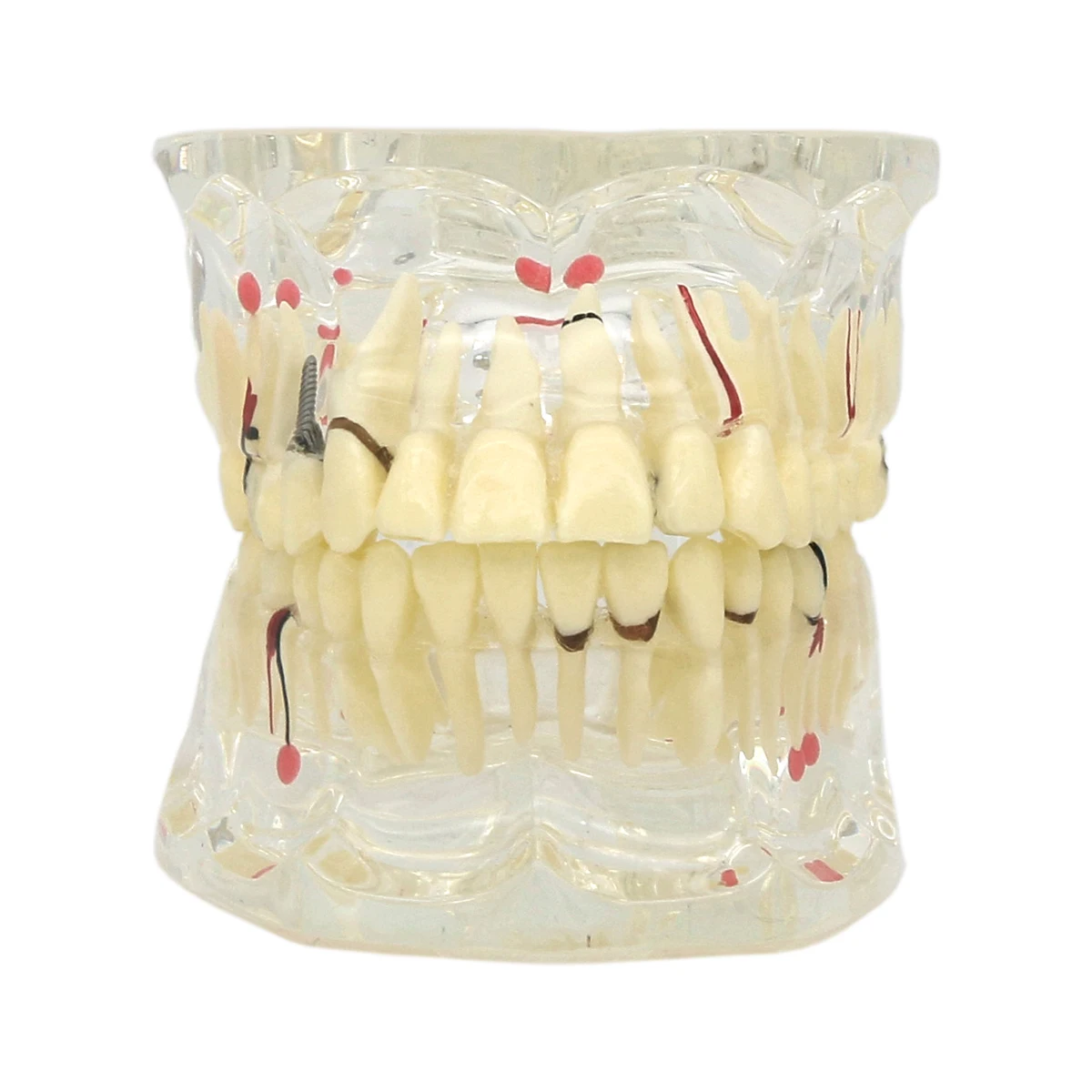 

Teeth Model (Adult&Children )Carious Cysts Pathology For Dentistry Dental Teaching Demo Dental Laboratory Transparent Material