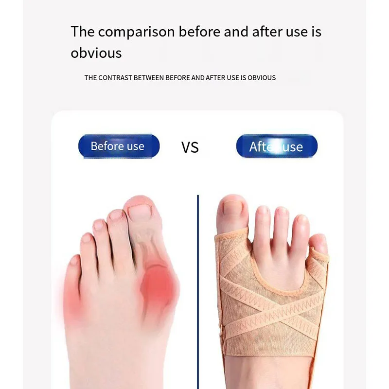 Fabric Bunion Corrector Breathable Adjustable Hallux Valgus Sleeve Spacer Separator Toe Corrector Sports Bunion Socks Running