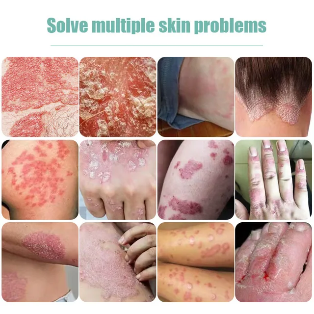 Psoriasis Antibakteriális Krém Dermatitis Ekzematoid Hatékony - Image 6
