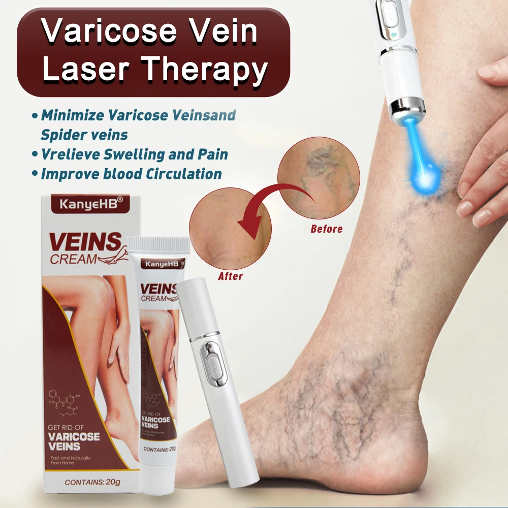 LaserTherapyVaricoseVeinsRelieveBlueLightPenEffectiveVaricoseVeinsReliefCream