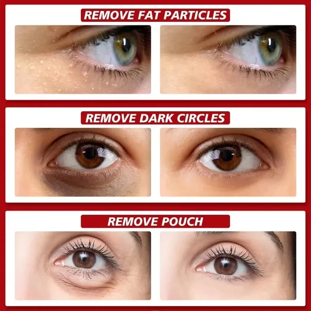 Fat Granules Removal Eye Serum Eye Milia Repair Treatment Products Wrinkle Lifting Moisturizing Anti-Puffiness Korean Skin Care 2