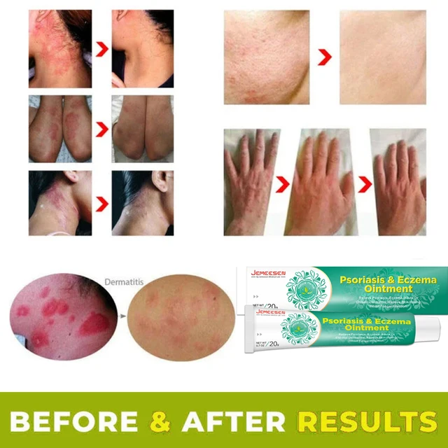 Psoriasis Krém Ekcéma Kenőcs Kezelés Kéz Tinea Pedis Gátolja A Dermatitis Gombaellenes Krémet - Image 2
