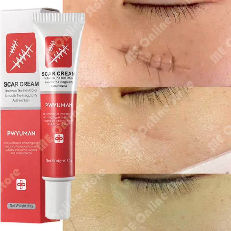 

Scar Removal Cream Gel Remove Acne Spots Treatment Stretch Marks Burn Surgical Scars Repair Cream Smooth Whitening Skin Products