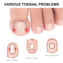 

3pairs Front Nail Hook/rubber Band Nail Art Ingrown Toe Nail Correction Toenail Nail Ingrown Clip Orthosis Paronychia Pedicure