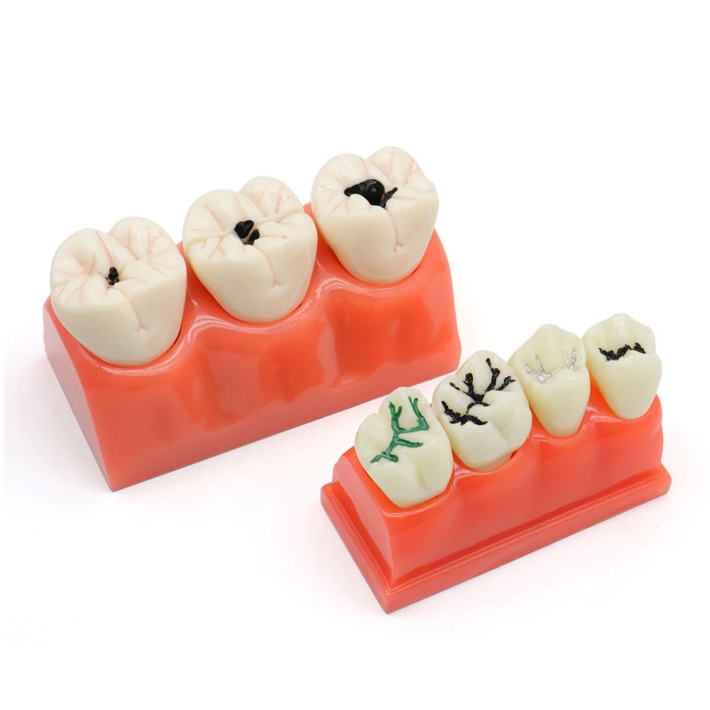 

Dental Demonstration Model Dental Implant Teach Crown Bridge Removable Model Porcelain Teeth Model For Dentist Teaching