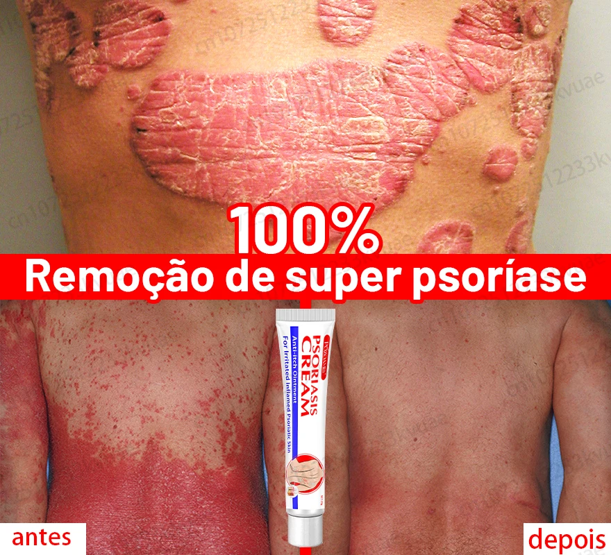 Psoriasis Cream Removal Psoriasis Eczema Best Against Psoriasis Dermatitis Products Natural Plant Extracts for Psoriasis Remove