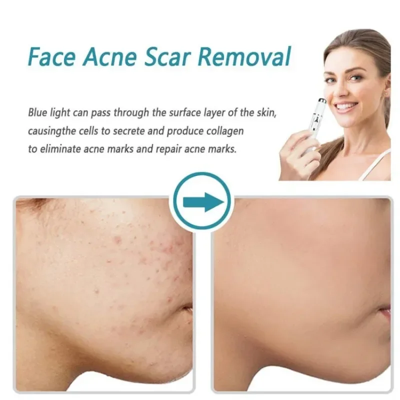Acne Wrinkle Removal Laser Pen Skin Spots Removal Anti Varicose Spider Vein Treatment Medical Blue Light Eye Massage Instrument plasma pen remover,blue light therapy pen,laser plasma pen remover,laser pen therapy,skin care device